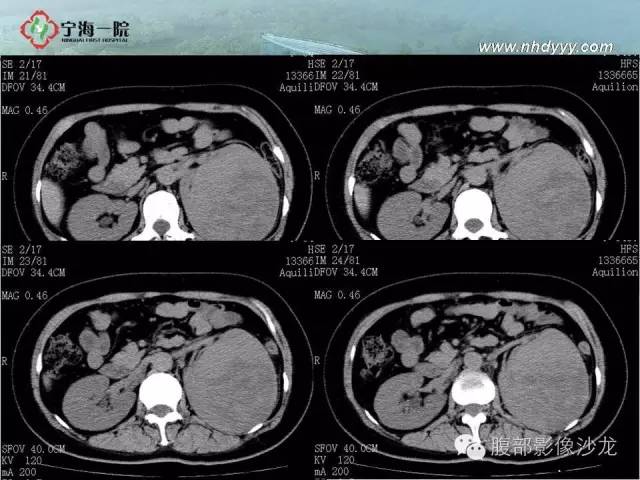 【病例】左肾滑膜肉瘤1例CT影像表现