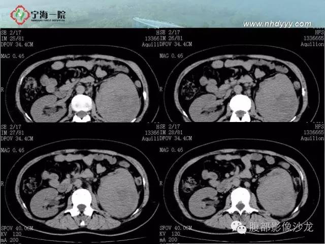 【病例】左肾滑膜肉瘤1例CT影像表现