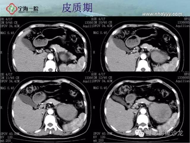 【病例】左肾滑膜肉瘤1例CT影像表现
