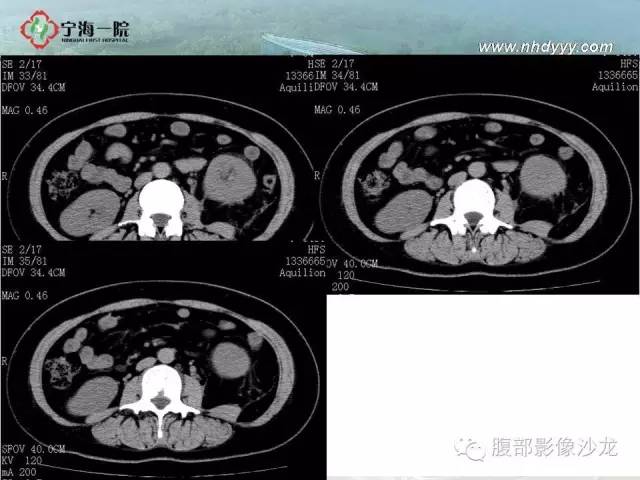 【病例】左肾滑膜肉瘤1例CT影像表现