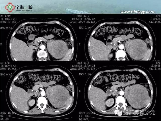 【病例】左肾滑膜肉瘤1例CT影像表现