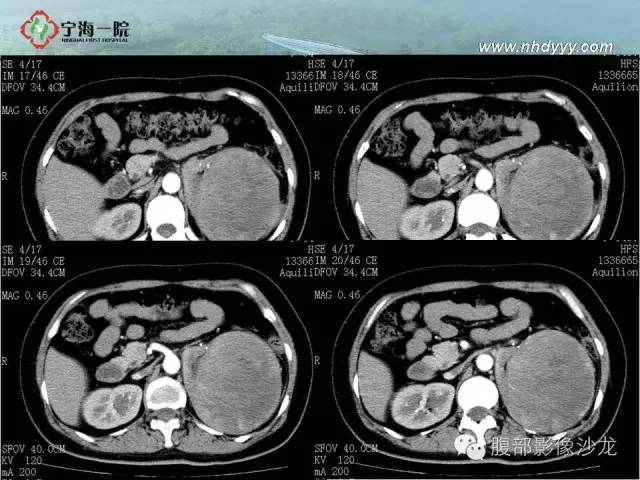 【病例】左肾滑膜肉瘤1例CT影像表现