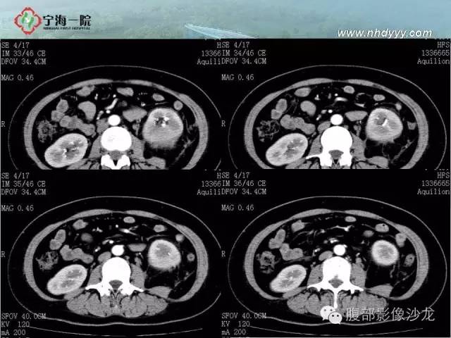【病例】左肾滑膜肉瘤1例CT影像表现