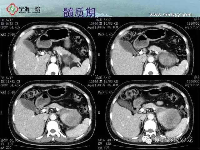【病例】左肾滑膜肉瘤1例CT影像表现