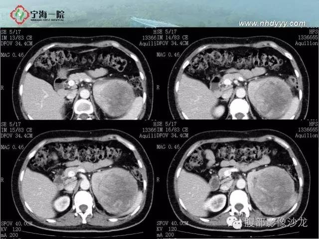 【病例】左肾滑膜肉瘤1例CT影像表现