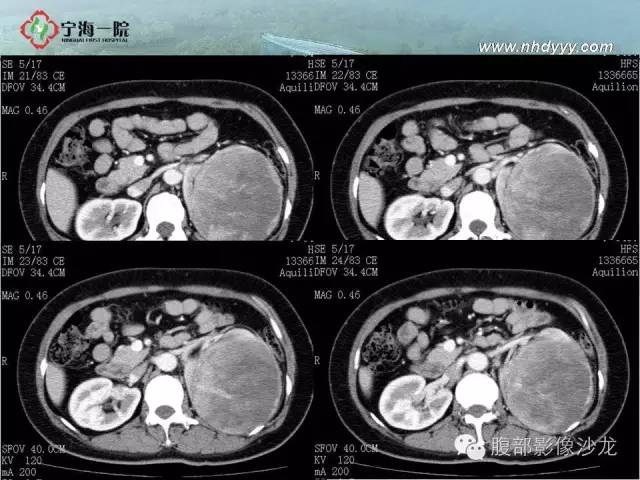 【病例】左肾滑膜肉瘤1例CT影像表现