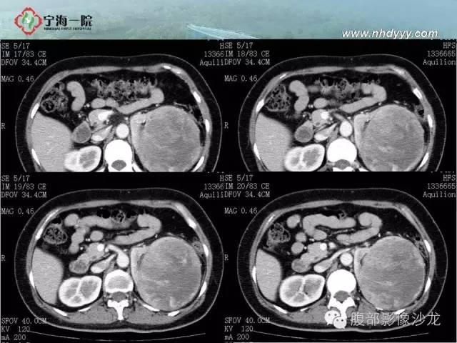【病例】左肾滑膜肉瘤1例CT影像表现