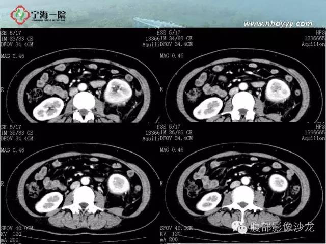 【病例】左肾滑膜肉瘤1例CT影像表现