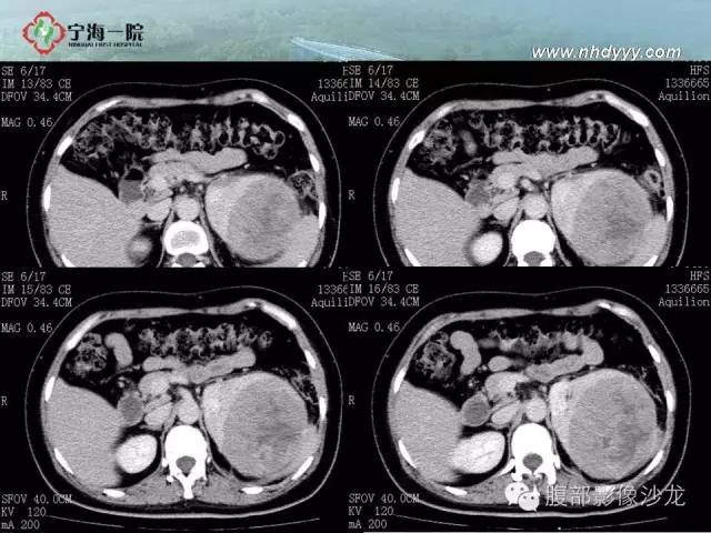 【病例】左肾滑膜肉瘤1例CT影像表现