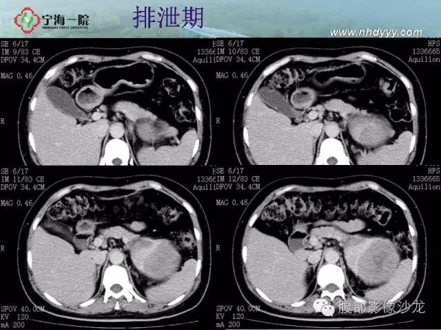 【病例】左肾滑膜肉瘤1例CT影像表现
