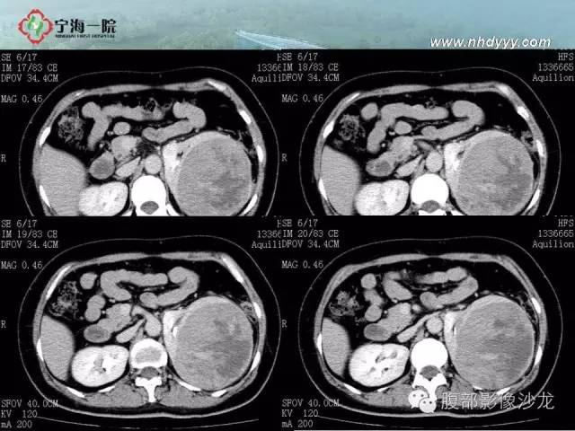 【病例】左肾滑膜肉瘤1例CT影像表现
