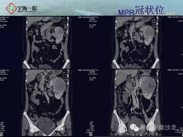 【病例】左肾滑膜肉瘤1例CT影像表现