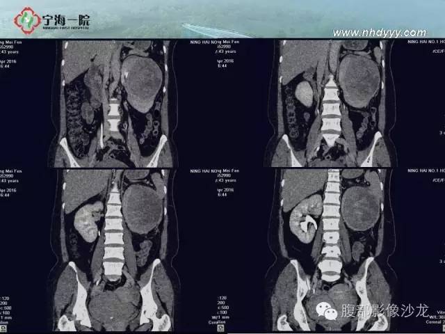 【病例】左肾滑膜肉瘤1例CT影像表现