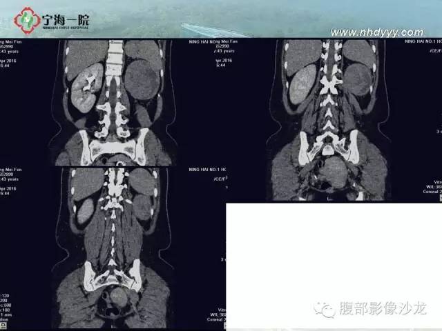 【病例】左肾滑膜肉瘤1例CT影像表现