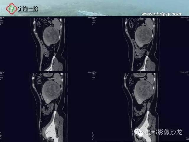 【病例】左肾滑膜肉瘤1例CT影像表现