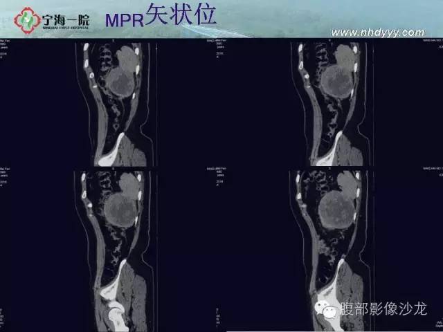 【病例】左肾滑膜肉瘤1例CT影像表现