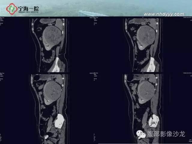 【病例】左肾滑膜肉瘤1例CT影像表现