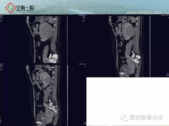 【病例】左肾滑膜肉瘤1例CT影像表现