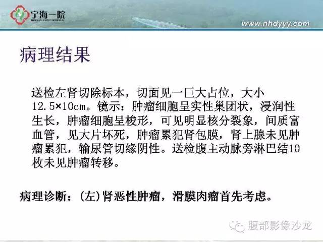 【病例】左肾滑膜肉瘤1例CT影像表现