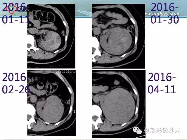 【病例】左肾滑膜肉瘤1例CT影像表现