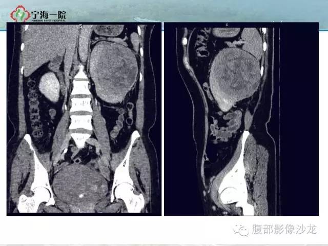 【病例】左肾滑膜肉瘤1例CT影像表现