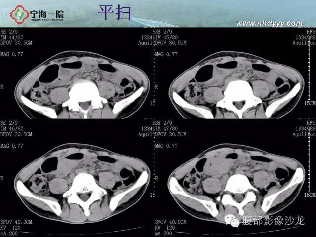 【病例】精原细胞瘤1例CT影像表现