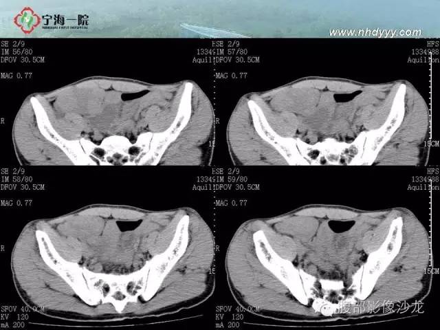 【病例】精原细胞瘤1例CT影像表现
