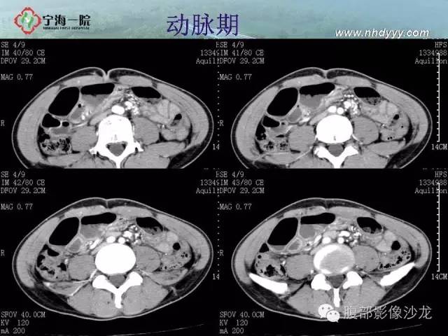 【病例】精原细胞瘤1例CT影像表现