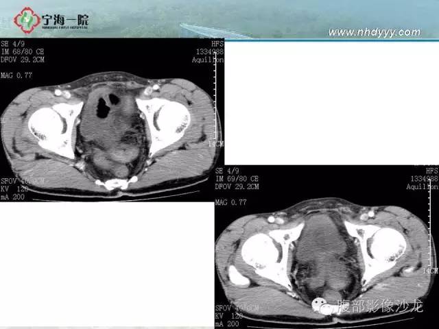 【病例】精原细胞瘤1例CT影像表现