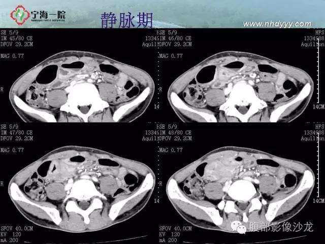 【病例】精原细胞瘤1例CT影像表现