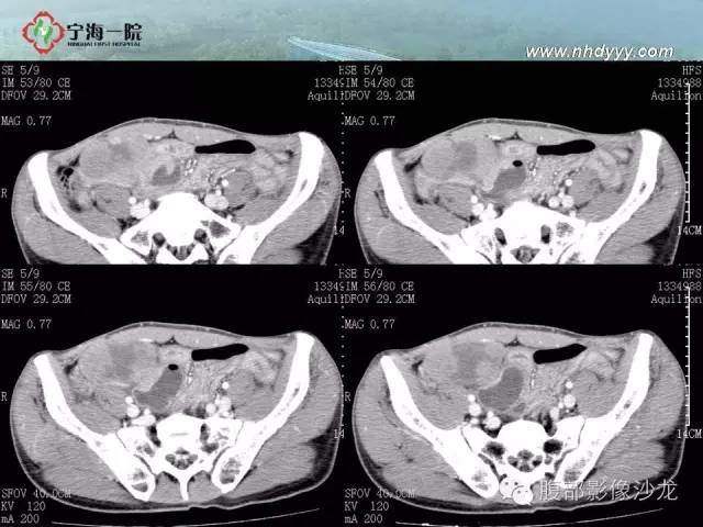 【病例】精原细胞瘤1例CT影像表现