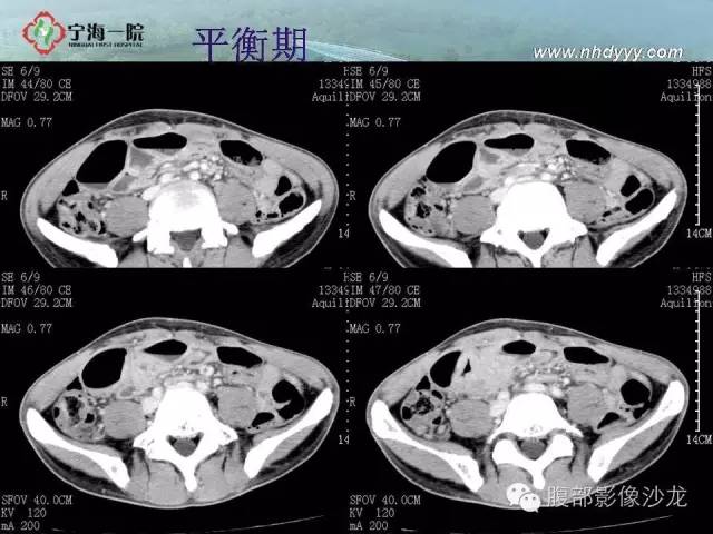 【病例】精原细胞瘤1例CT影像表现