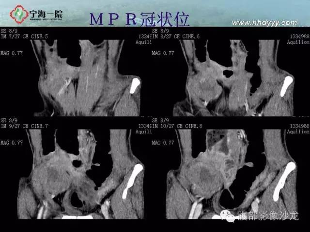 【病例】精原细胞瘤1例CT影像表现