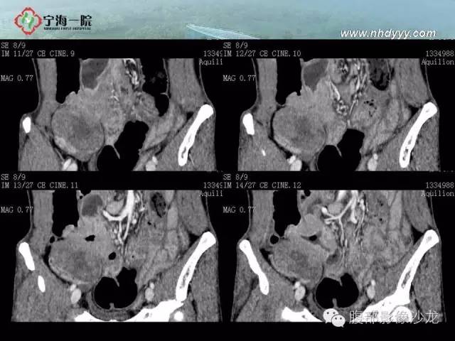 【病例】精原细胞瘤1例CT影像表现