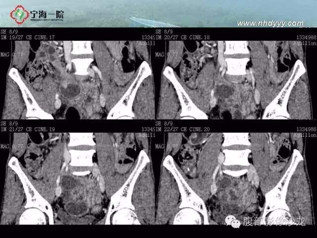 【病例】精原细胞瘤1例CT影像表现