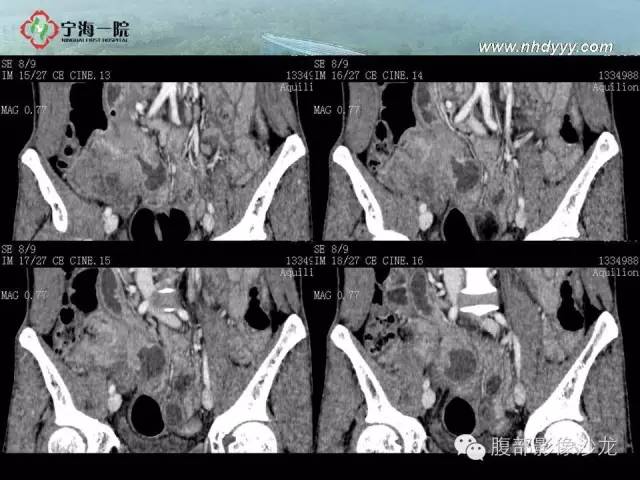 【病例】精原细胞瘤1例CT影像表现