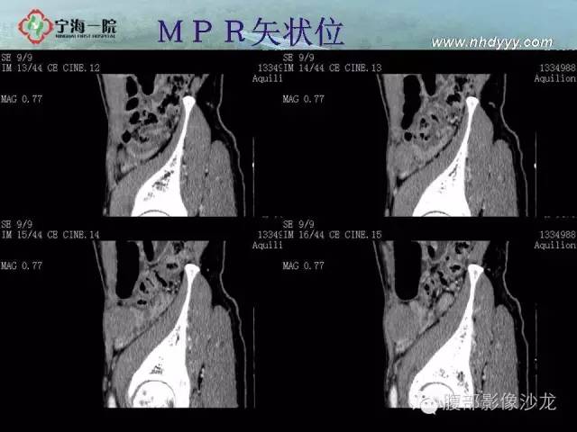 【病例】精原细胞瘤1例CT影像表现