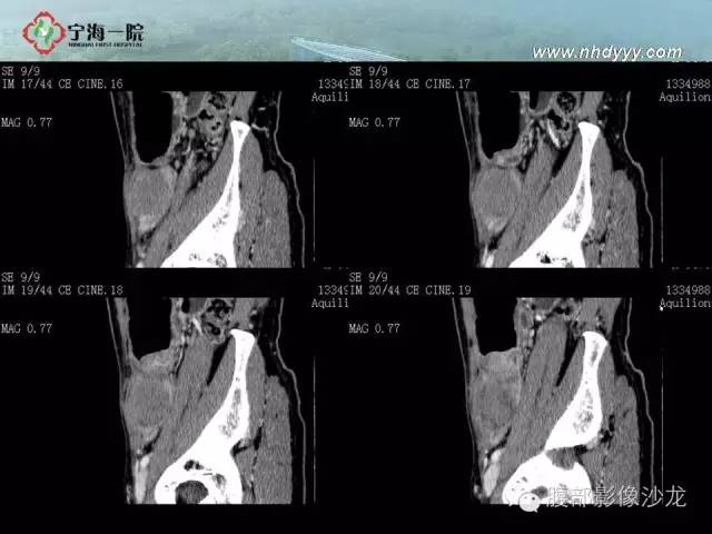 【病例】精原细胞瘤1例CT影像表现