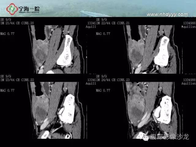 【病例】精原细胞瘤1例CT影像表现