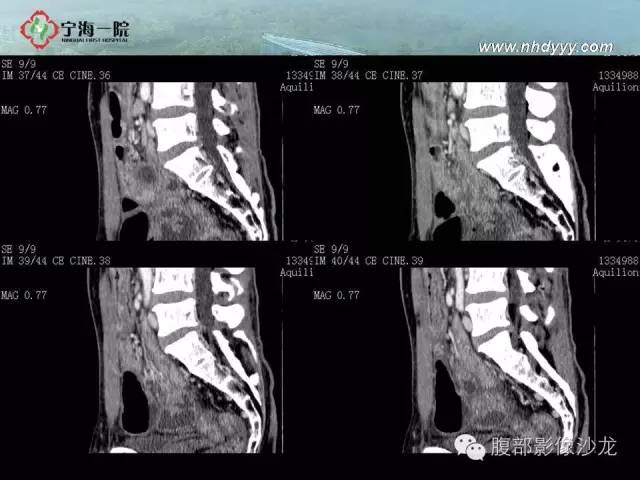 【病例】精原细胞瘤1例CT影像表现