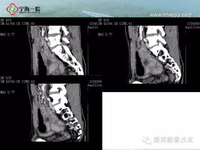 【病例】精原细胞瘤1例CT影像表现