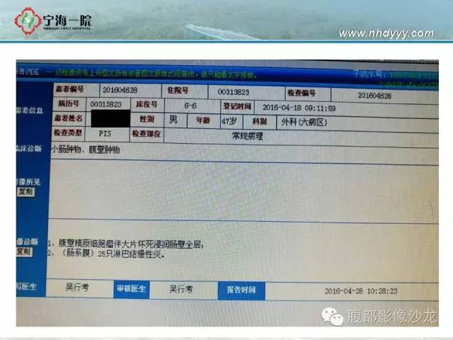 【病例】精原细胞瘤1例CT影像表现