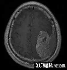 【病例】左侧额顶部脑膜瘤1例MR影像表现 【病例】左侧额顶部脑膜瘤1例MR影像表现
