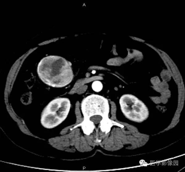 【病例】巨淋巴结增生症1例CT影像表现 【病例】巨淋巴结增生症1例CT影像表现