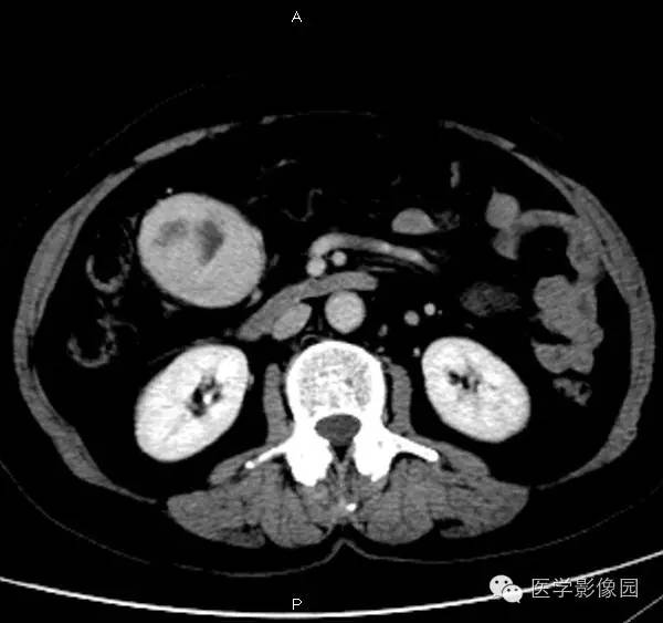 【病例】巨淋巴结增生症1例CT影像表现 【病例】巨淋巴结增生症1例CT影像表现