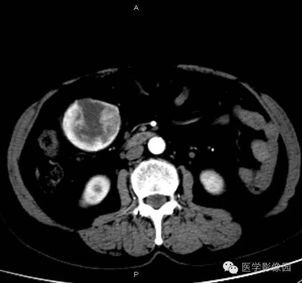 【病例】巨淋巴结增生症1例CT影像表现 【病例】巨淋巴结增生症1例CT影像表现