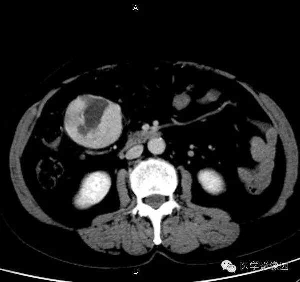 【病例】巨淋巴结增生症1例CT影像表现 【病例】巨淋巴结增生症1例CT影像表现
