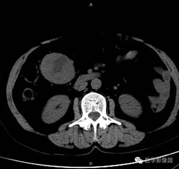 【病例】巨淋巴结增生症1例CT影像表现 【病例】巨淋巴结增生症1例CT影像表现