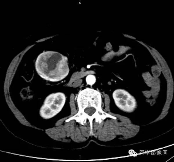 【病例】巨淋巴结增生症1例CT影像表现 【病例】巨淋巴结增生症1例CT影像表现