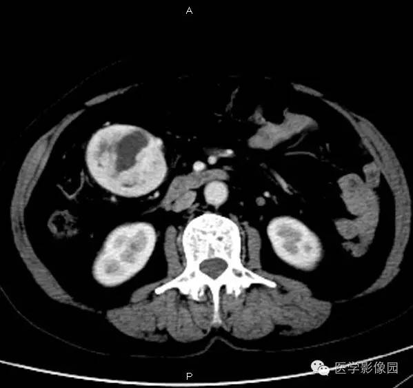 【病例】巨淋巴结增生症1例CT影像表现 【病例】巨淋巴结增生症1例CT影像表现